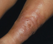 graves skin disease
